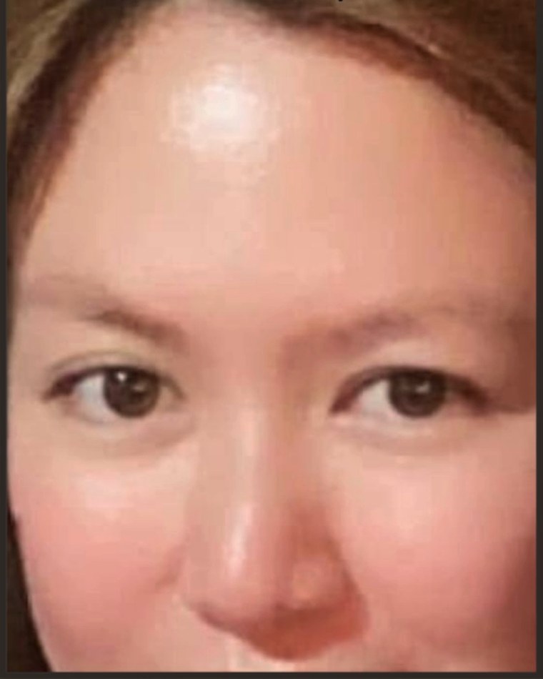 Before treatment