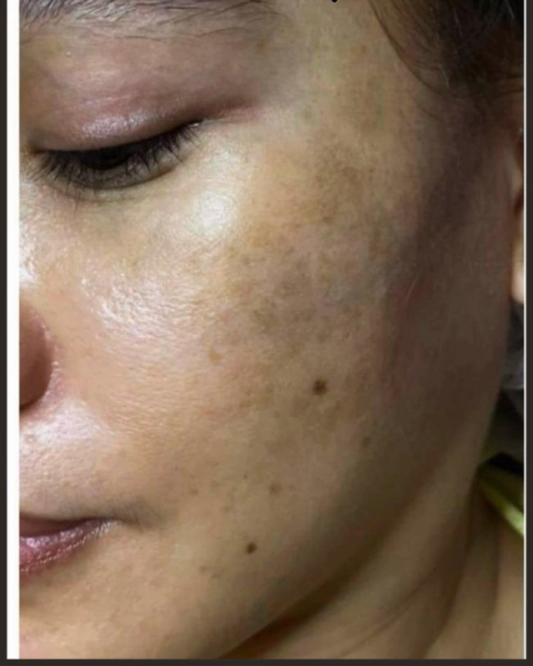 Before treatment