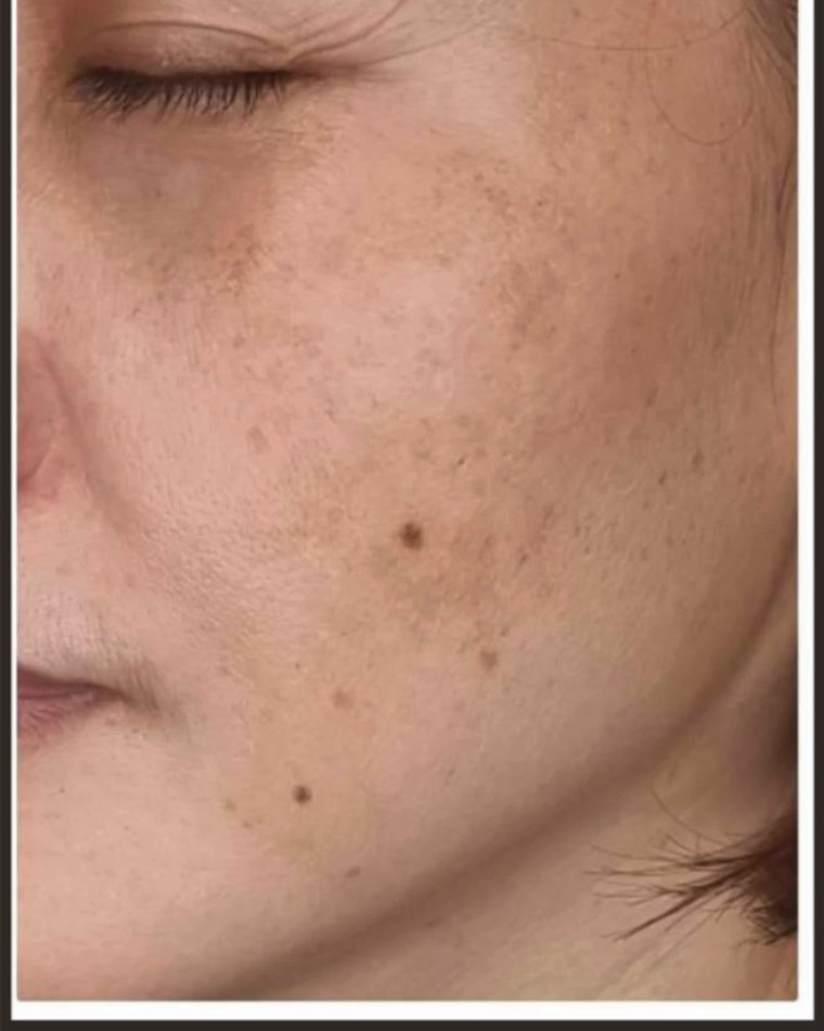 After treatment