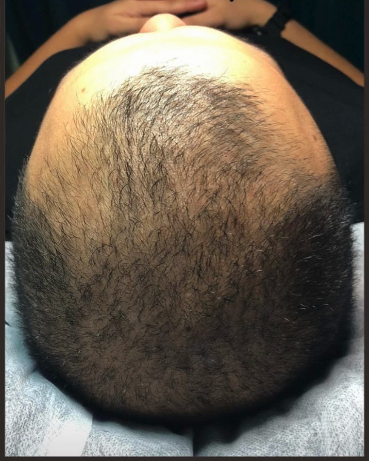 Before treatment
