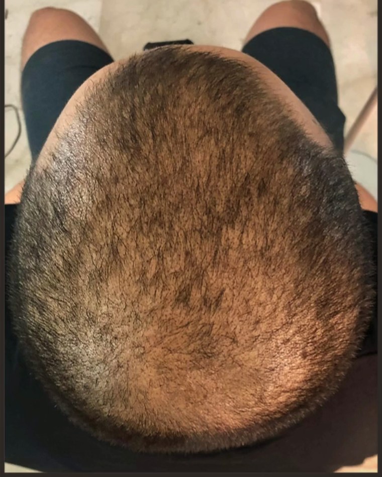 After treatment